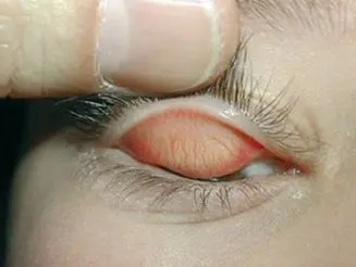 Figura 1A. Conjuntivitis alérgica