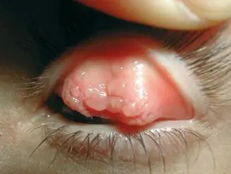 Figura 1B.  Queratoconjuntivitis vernal