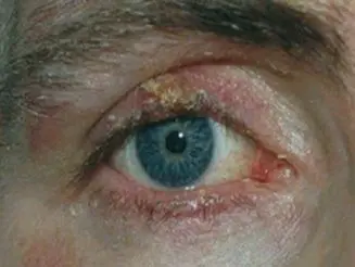 Figura 1C. Queratoconjuntivitis atópica