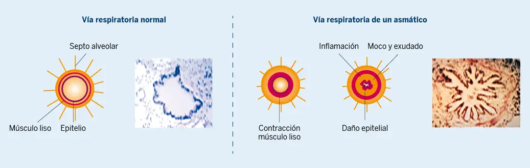 Figura 1. Componentes del asma