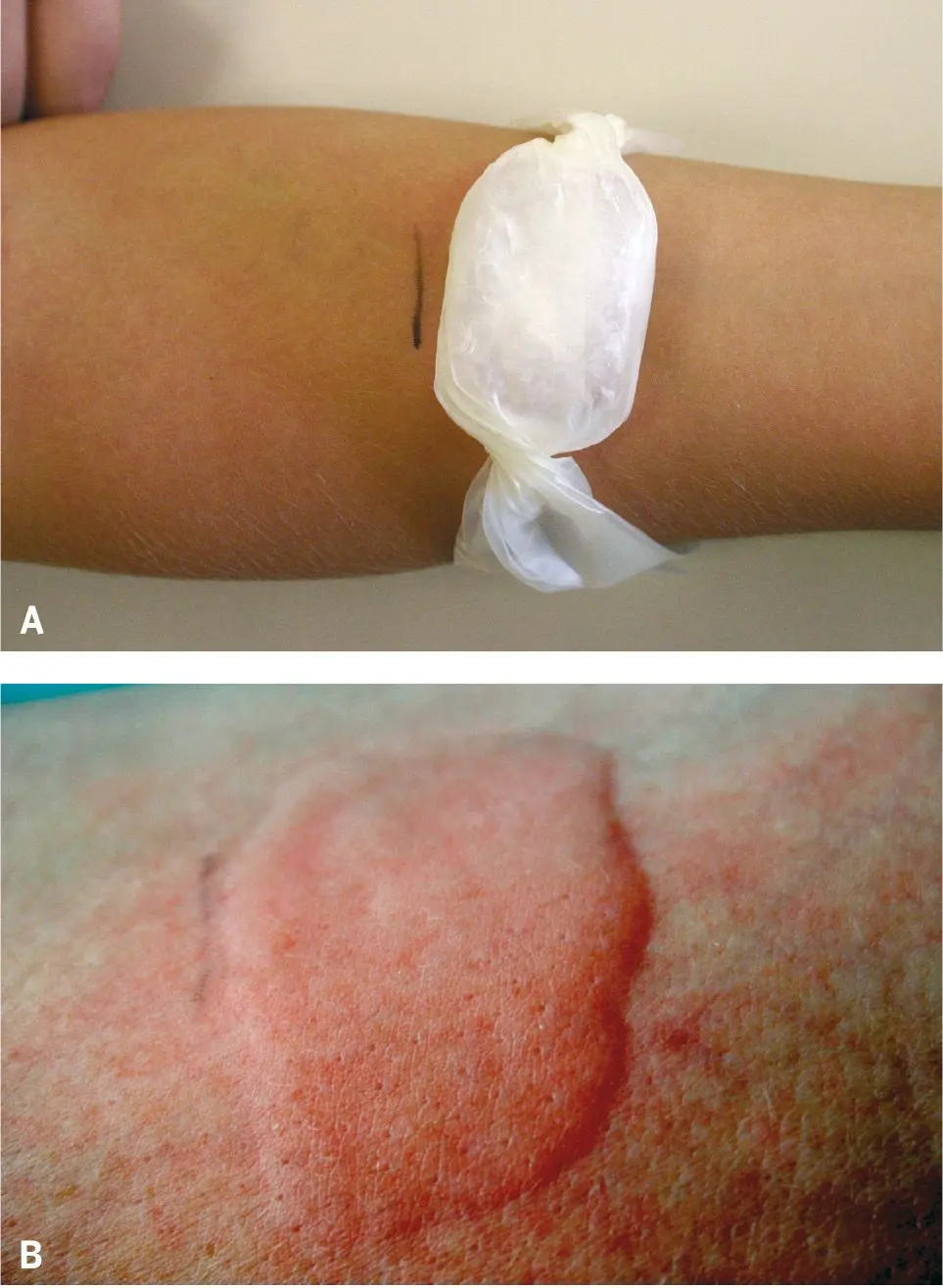 Figura 4. Diagnóstico de la urticaria por frío, con el test del cubito de hielo. El hielo se aplica durante diez minutos sobre la piel (A) y al cabo de ese tiempo, en la zona donde se ha aplicado el cubito, aparece un habón (B)