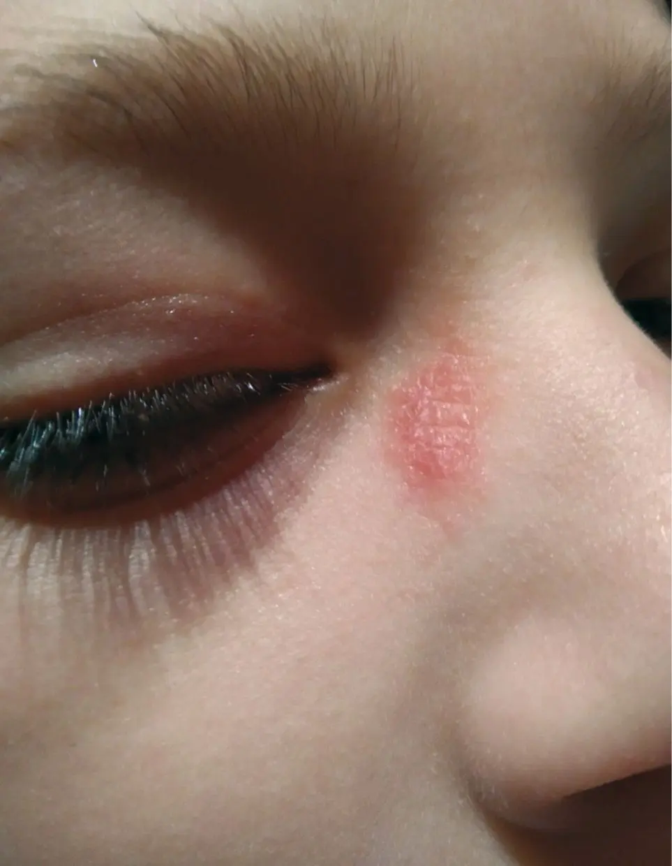 Figura 1. Dermatitis alérgica de contacto por montura de gafas