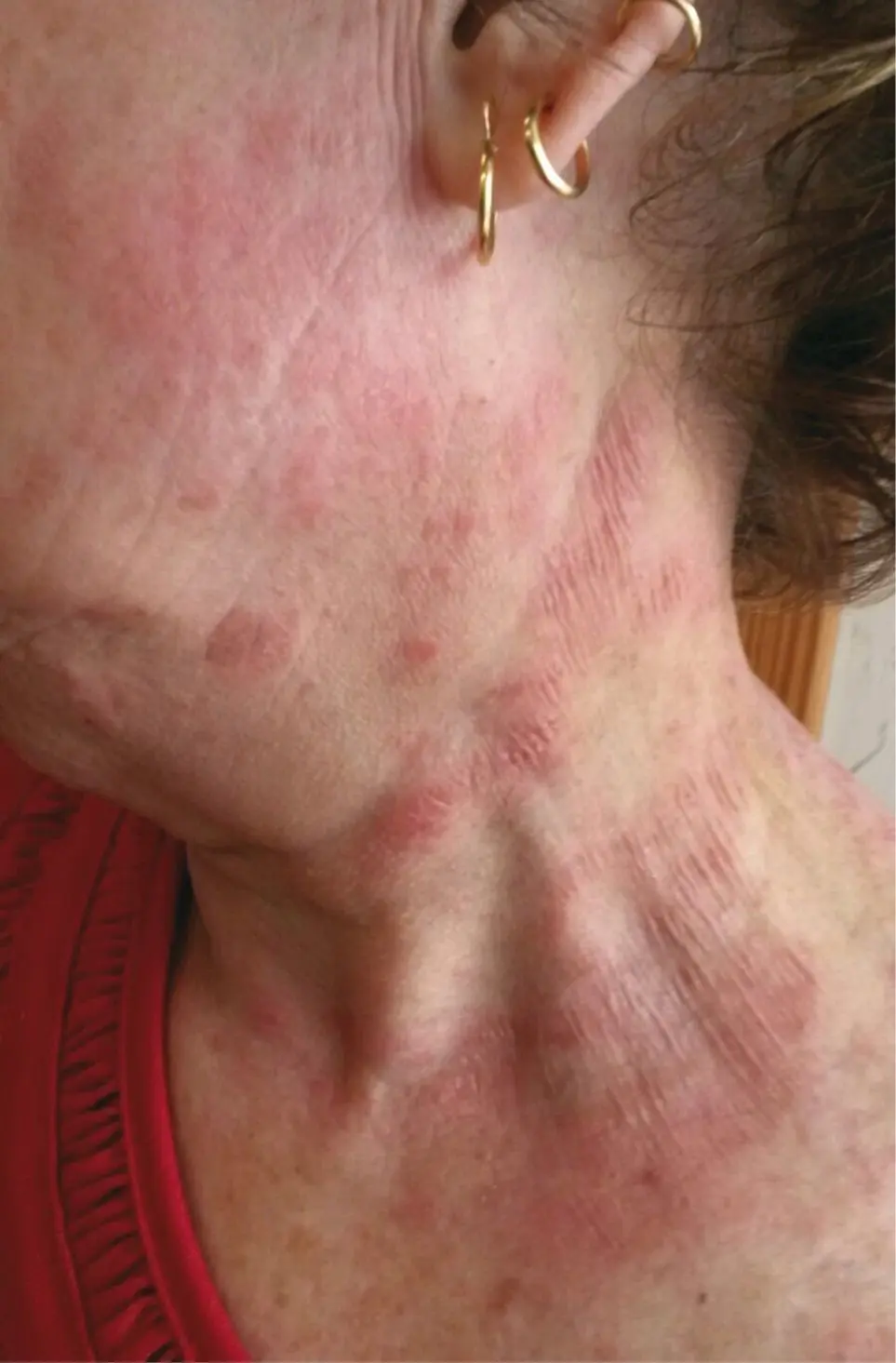 Figura 2. Dermatitis de contacto por uso de pinturas al agua (isotiazolinonas)