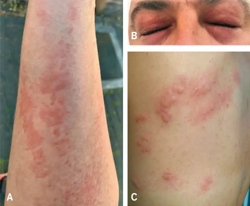 Figura 1A. Lesiones inmediatas, urticaria (A) y angioedema (B), y no inmediatas, exantema (C)