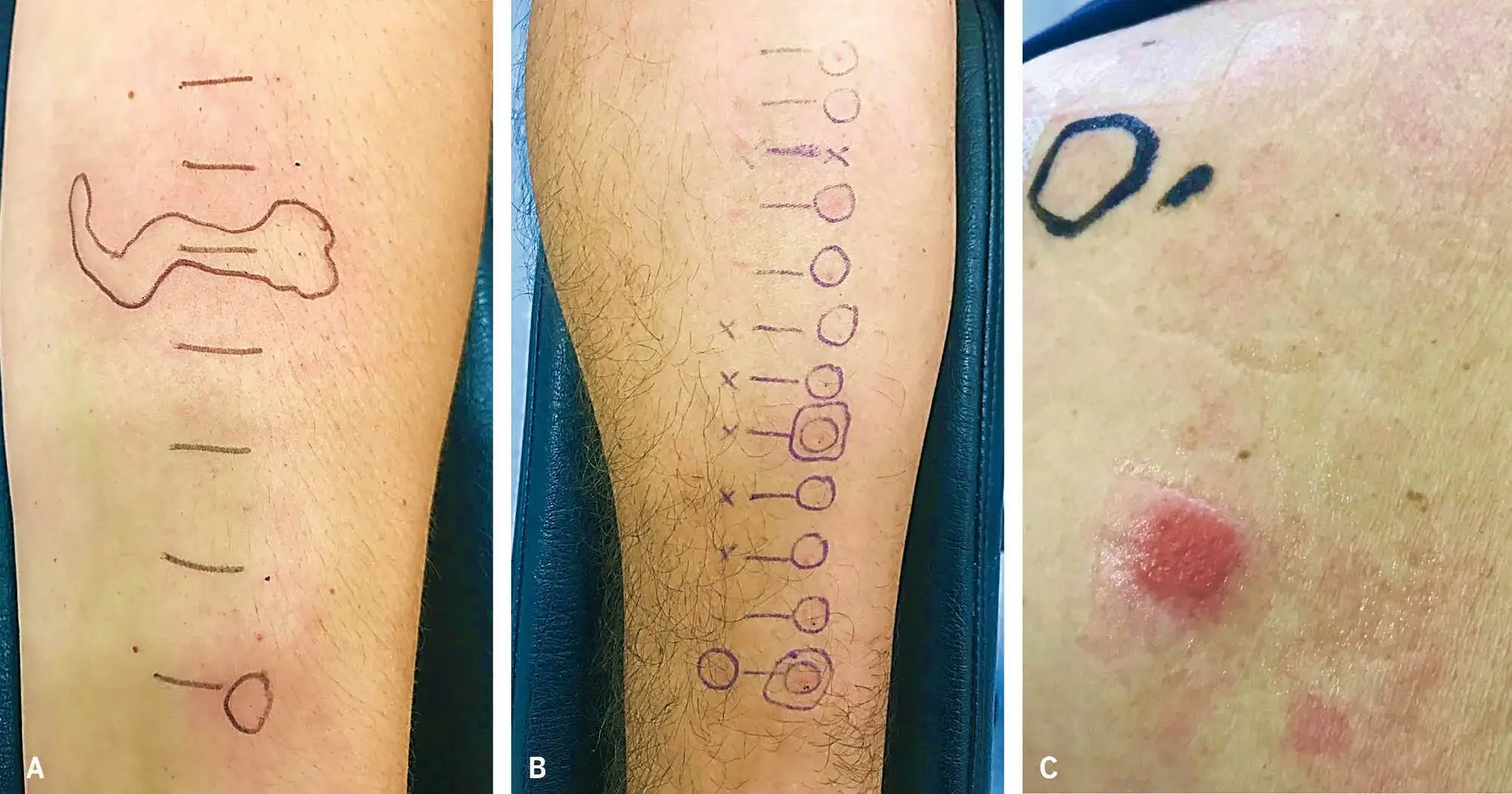 Prueba intraepidérmica inmediata positiva a amoxicilina (A), prueba intradérmica inmediata positiva a amoxicilina (B) y prueba epicutánea positiva a amoxicilina (C)