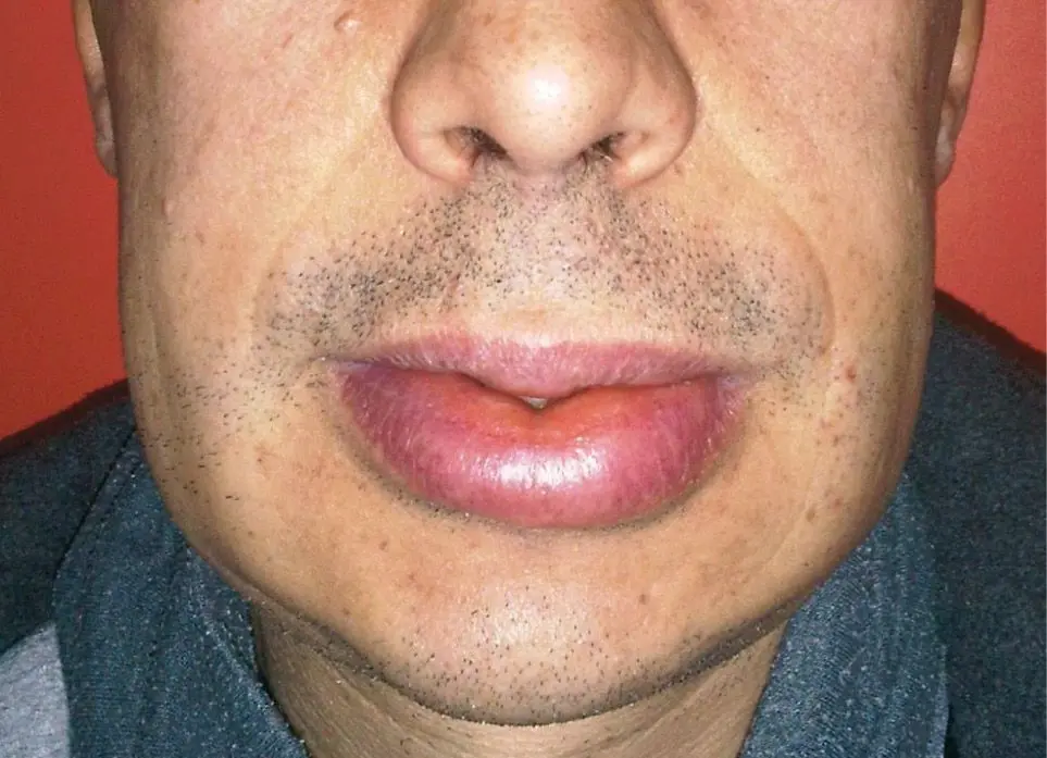 Figura 1. Angioedema por ibuprofeno