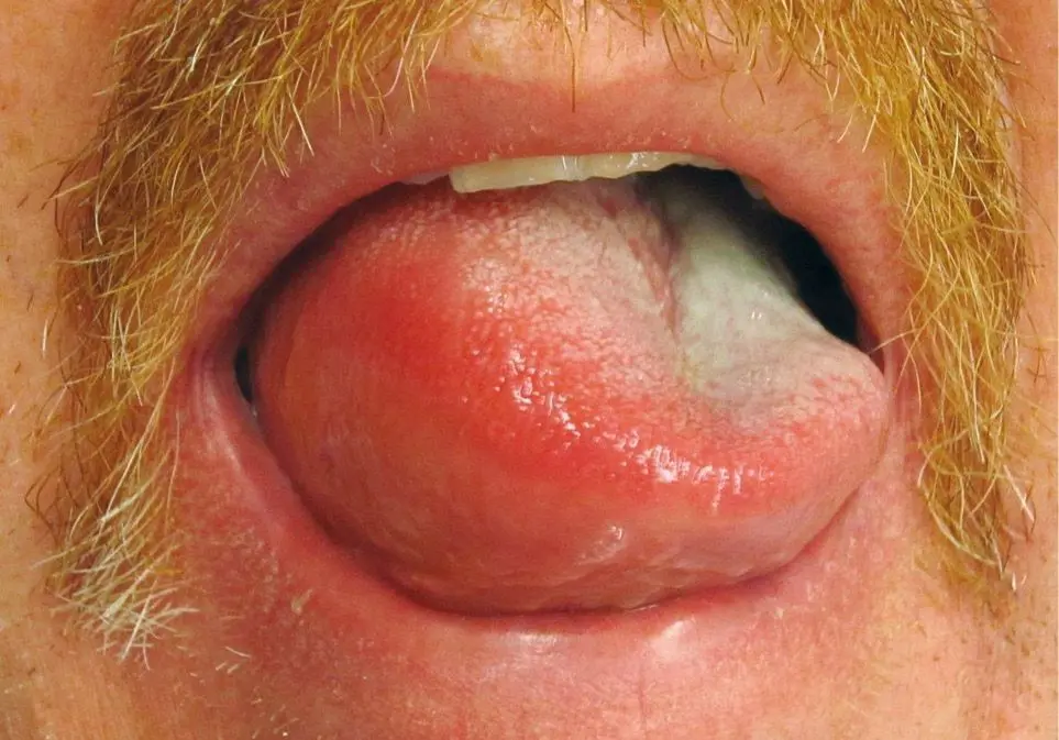 Figura 2. Angioedema lingual por IECA