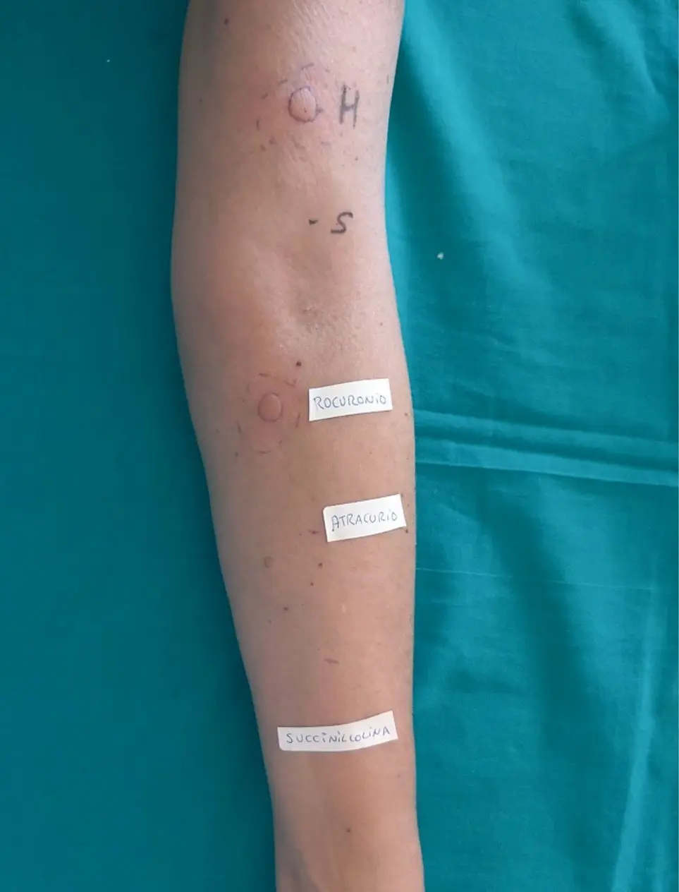 Figura 1. Pruebas cutáneas con relajantes musculares. Intradermorreacción positiva con rocuronio y negativa con atracurio y succinilcolina.