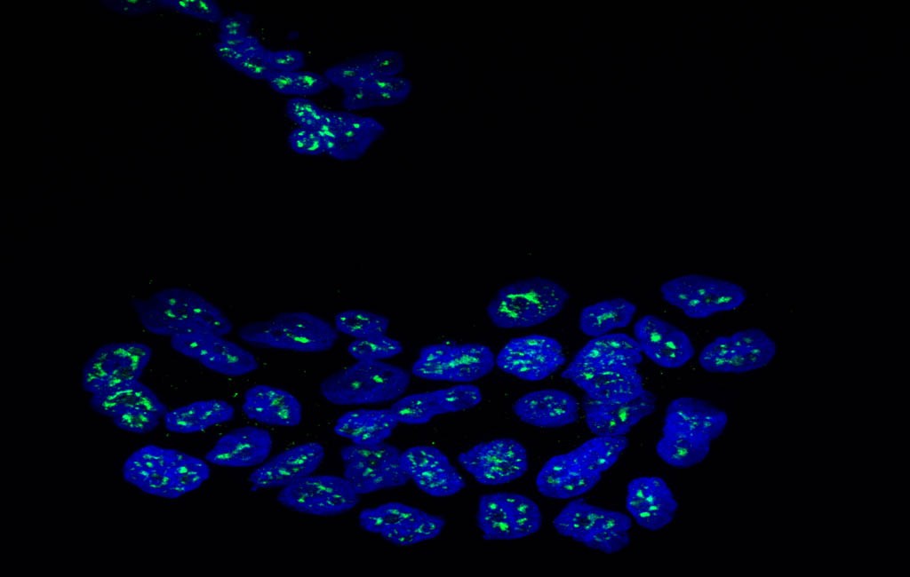 celulas_cancer_1000x650